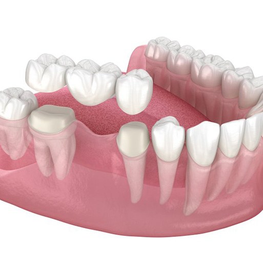 Reuse the image from “Dental Bridges for a Complete Smile”