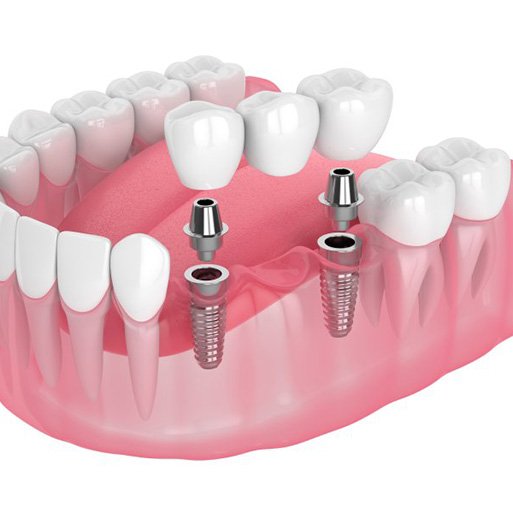 Reuse the image from “Combining Dental Crowns and Bridges”