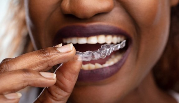 Closeup of patient putting on clear aligner