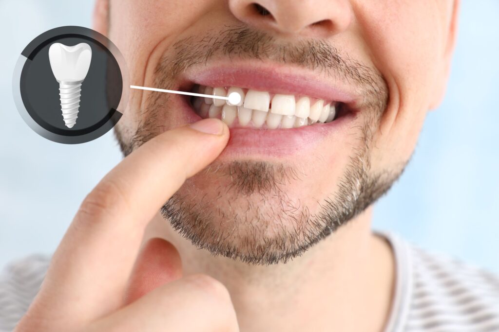 Nose-to-chin view of man pointing to his teeth with one indicated as an implant